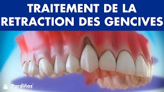 Récession Gingivale – Traitement de la retraction des gencives © [upl. by Old]