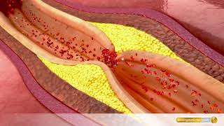 Gefäßverschluss So entsteht Arteriosklerose [upl. by Donadee]