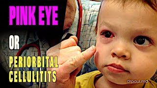 LIVE DIAGNOSIS Pink Eye or Periorbital Cellulitis  Dr Paul [upl. by Uhayile85]