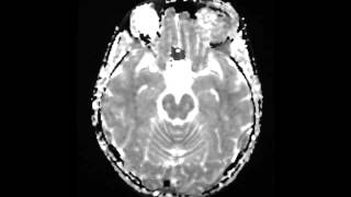 Fibromuscular Dysplasia  Symptoms and Diagnosis [upl. by Levitus]