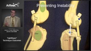 TightRope® Technique Outcomes [upl. by Amabelle]