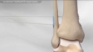 Syndesmosis TightRope® XP Implant System [upl. by Byler]