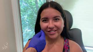 Buccal Fat Removal Surgery  3 Weeks Before amp After Results  by Dr Philip Solomon [upl. by Vasili]