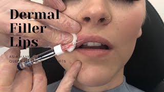 Dermal Filler Lips  1 Syringe RESTYLANE [upl. by Tirrell]