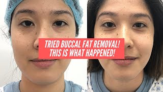 JOURNEY TO A SLIMMER FACE PART 1 BUCCAL FAT REMOVAL [upl. by Aneral]