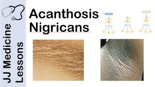 Acanthosis Nigricans  Risks Pathogenesis and Treatments [upl. by Anees]