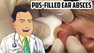 PusFilled Ear Abscess Drained  Revisited Popping [upl. by Assed]