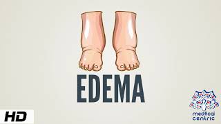 Edema Causes Signs and Symptoms Diagnosis and Treatment [upl. by Berriman]