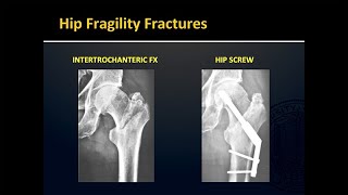 Fragility Fractures [upl. by Brnaby]