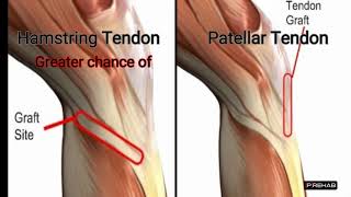 ACL Reconstruction Graft Options [upl. by Cornwell]