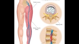 What is Sciatica [upl. by Eirol]