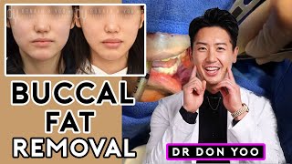 All About Buccal Fat Removal Surgery and Recovery  Dr Donald B Yoo [upl. by Akeenahs]