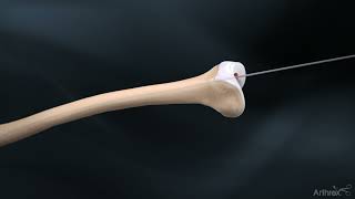 Femoral Nail System Overview [upl. by Ocnarfnaig]