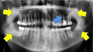 Removal of wisdom teeth and cysts [upl. by Richart]