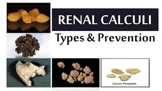 Renal Calculi Types and Prevention [upl. by Ecirahc]