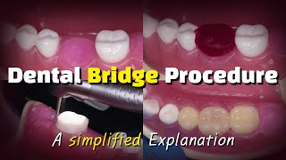 Dental Bridge Procedure [upl. by Eenrahc]