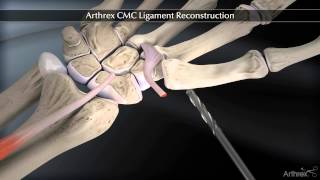 Arthrex CMC Ligament Reconstruction [upl. by Ondrej358]