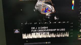 Ductus venosus doppler [upl. by Aisnetroh]