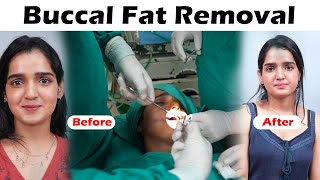 Buccal Fat Removal in Delhi [upl. by Amersham]