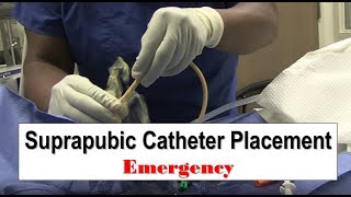 Emergency Suprapubic Catheter Placement [upl. by Schmitz]