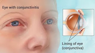 Conjunctivitis  Ophthalmology Videos [upl. by Ozneral]