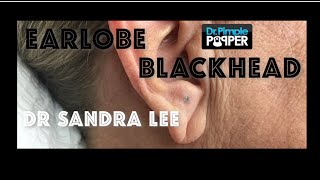 A nice earlobe blackhead extracted [upl. by Amoritta]