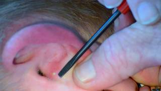 Painful Ear Pimple Popped and Slowly Pressured [upl. by Mayhs601]